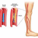 Listen to Your Legs for Signs of Peripheral Vascular Disease